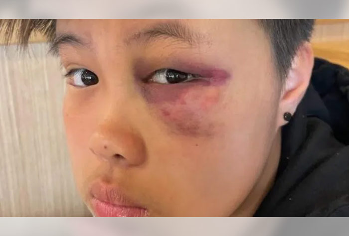 14세 여학생 ‘인종차별’로 묻지마 폭행 당해